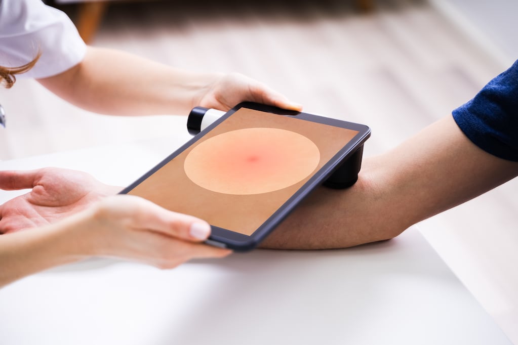 Aplicación DERM Zero para la detección de cáncer de piel